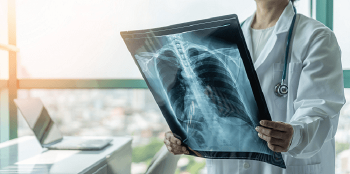 What is the Full Form of X-RAY